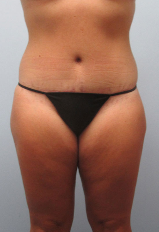 Tummy Tuck Before & After Image