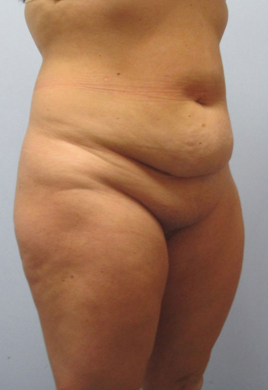 Tummy Tuck Before & After Image