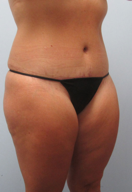 Tummy Tuck Before & After Image