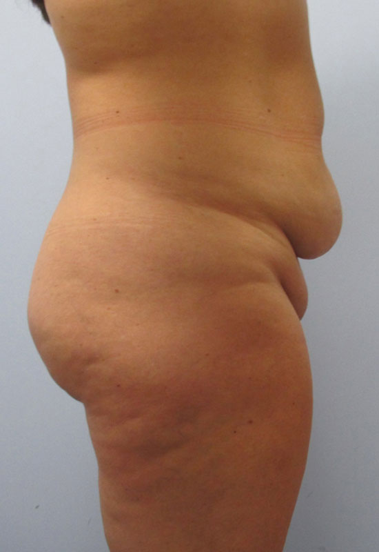 Tummy Tuck Before & After Image