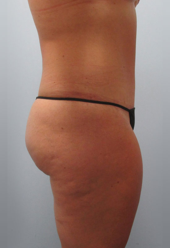 Tummy Tuck Before & After Image