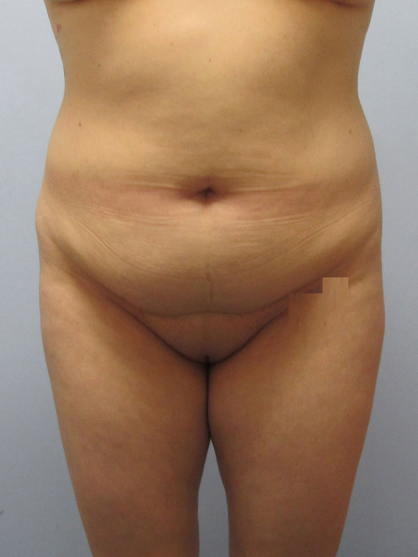 Tummy Tuck Before & After Image