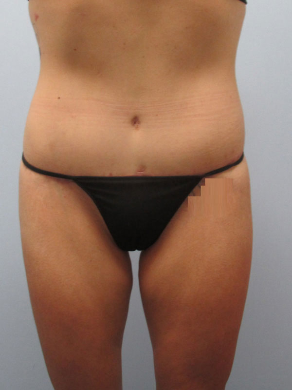 Tummy Tuck Before & After Image