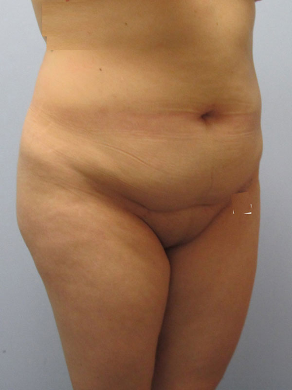 Tummy Tuck Before & After Image