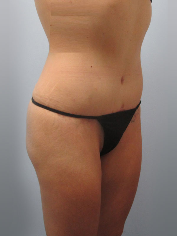 Tummy Tuck Before & After Image