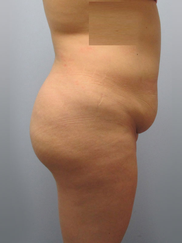 Tummy Tuck Before & After Image