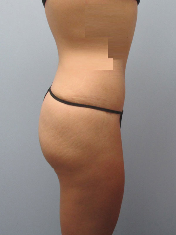 Tummy Tuck Before & After Image