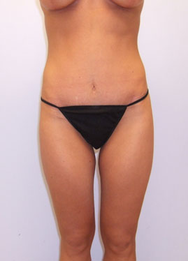 Tummy Tuck Before & After Image