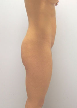 Tummy Tuck Before & After Image