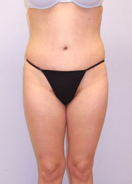 Tummy Tuck Before & After Image