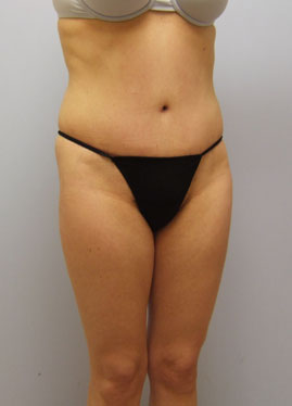 Tummy Tuck Before & After Image