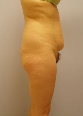 Tummy Tuck Before & After Image