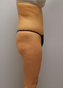 Tummy Tuck Before & After Image