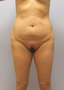 Tummy Tuck Before & After Image