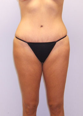 Tummy Tuck Before & After Image