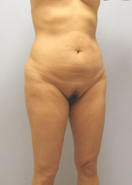 Tummy Tuck Before & After Image