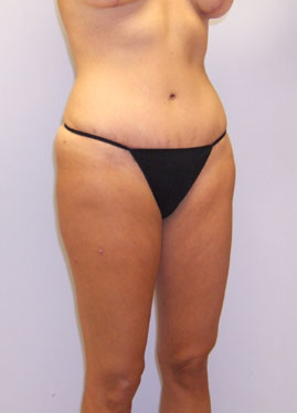 Tummy Tuck Before & After Image