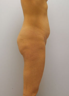 Tummy Tuck Before & After Image