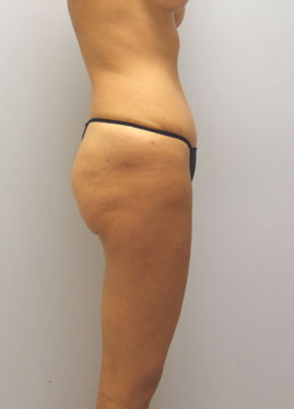 Tummy Tuck Before & After Image