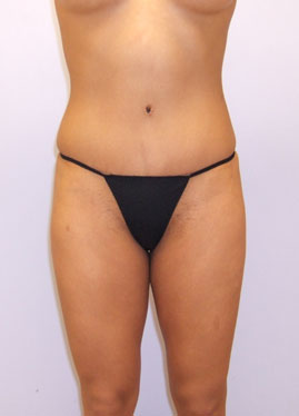 Tummy Tuck Before & After Image