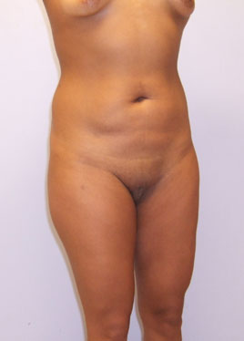 Tummy Tuck Before & After Image