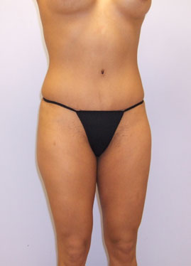 Tummy Tuck Before & After Image