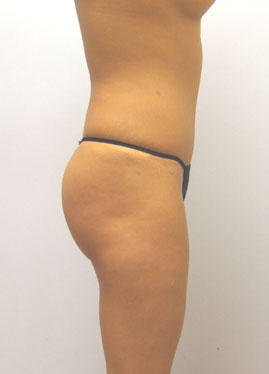 Tummy Tuck Before & After Image