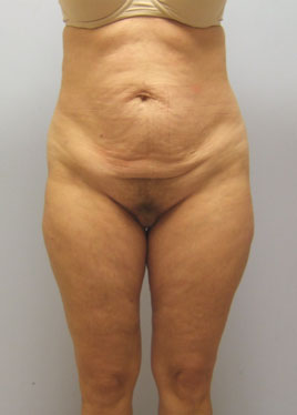 Tummy Tuck Before & After Image