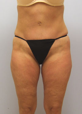 Tummy Tuck Before & After Image