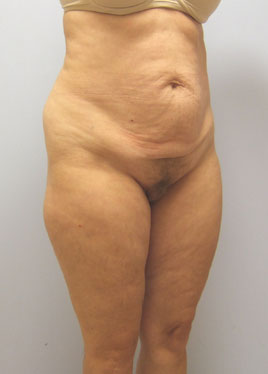 Tummy Tuck Before & After Image