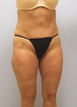 Tummy Tuck Before & After Image