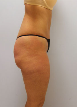 Tummy Tuck Before & After Image