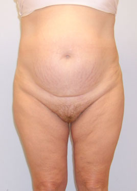 Tummy Tuck Before & After Image