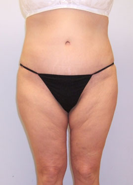 Tummy Tuck Before & After Image