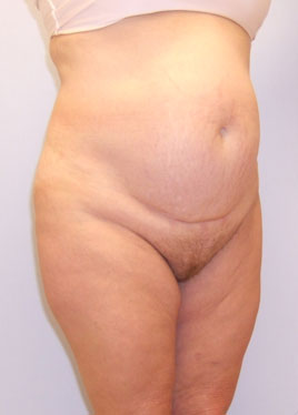 Tummy Tuck Before & After Image