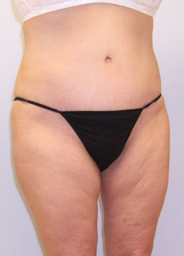 Tummy Tuck Before & After Image