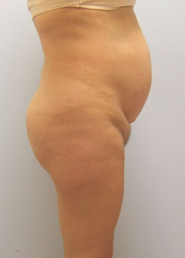 Tummy Tuck Before & After Image