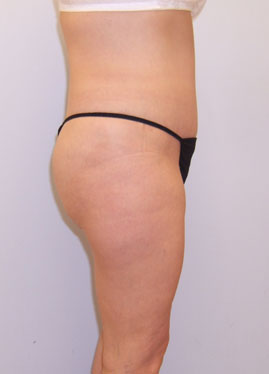 Tummy Tuck Before & After Image