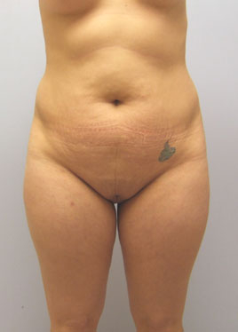 Tummy Tuck Before & After Image