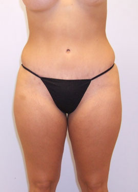 Tummy Tuck Before & After Image