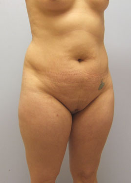 Tummy Tuck Before & After Image