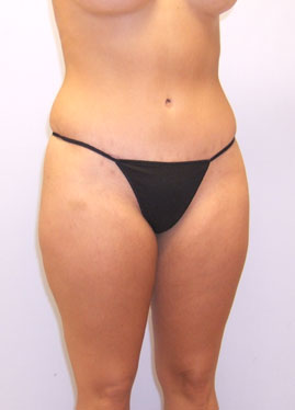 Tummy Tuck Before & After Image