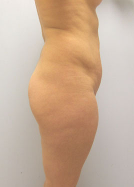 Tummy Tuck Before & After Image