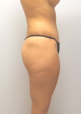 Tummy Tuck Before & After Image