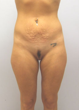 Tummy Tuck Before & After Image