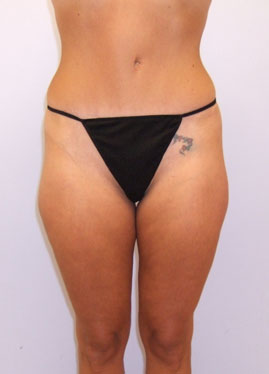 Tummy Tuck Before & After Image