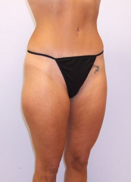 Tummy Tuck Before & After Image