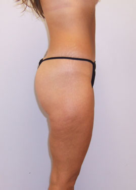 Tummy Tuck Before & After Image