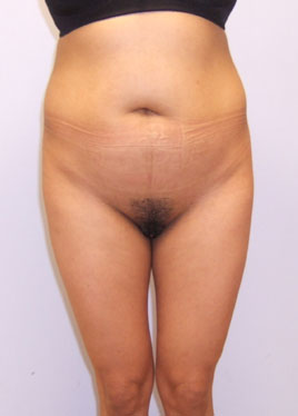 Tummy Tuck Before & After Image