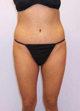 Tummy Tuck Before & After Image